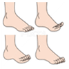 足や指の変形